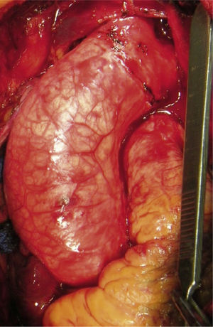 Aorta ascendente dilatada.