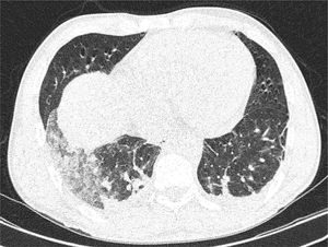 TC simple de tórax, consolidación con broncograma aéreo y patrón en vidrio deslustrado en el lóbulo inferior derecho.