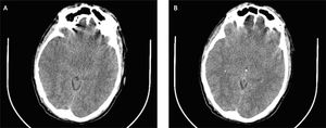 TC simple de encéfalo edema cerebral y pequeñas zonas de lesiones hemorrágicas puntiformes dispersas en encéfalo consistente con vasculitis.