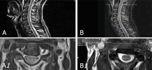 Resonancia magnética simple de columna cervical. A. Nivel C2–C3: leve protrusión disco–osteofitaria paramediana izquierda, que contacta con cara ventral del saco tecal. Sutil incremento difuso de señal intramedular, abarca segmento medular C2 a C6. B. Sin evidencia de hiperdensidad de señal intramedular en segmento C2-C6 descrita anteriomente.