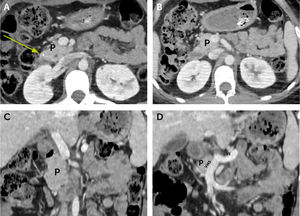 TC con contraste en fase porta. Cortes axiales (A y B). Cortes coronales (C y D). Se identifica calcificación intrapancreática (flecha). Porción cefálica del páncreas (P) con densidad habitual y realce homogéneo. Segmentos corporal y caudal ausentes. VMS: vena mesentérica superior; VE: vena esplénica.