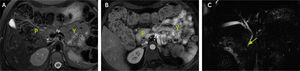 Cortes axiales RM. A. Imagen potenciada T2 FATSAT. B. Fase dinámica con contraste precoz. Se reconoce cabeza y proceso uncinado del páncreas (P) y ausencia de cuello, cuerpo y cola. Anterior a vena esplénica (VE), asas de yeyuno (Y). C. Colangio-RM, se constata solo ducto pancreático ventral (flecha).