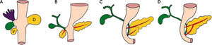 A. El páncreas se desarrolla a partir de dos brotes endodérmicos del duodeno primitivo: dorsal (D) y ventral (V). En la séptima semana de gestación, el duodeno primitivo gira de derecha a izquierda y el brote ventral sigue este movimiento de rotación, pasando por detrás del duodeno y fusionándose con el brote dorsal (B, C y D).