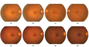 Resultados de detección de retinopatía diabética. Las imágenes (a), (e), (c) y (g) corresponden a imágenes originales y las imágenes (b), (f), (d) y (h) muestran: localización de disco óptico y posición real (objeto circular); detección de lesiones (azul); detección de lesiones rojas (verde). Fuente: Arenas-Cavalli JT. et al.24.