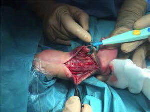 Paciente 1. Realización de fasciotomía. Fasciotomía de los cuatro compartimentos de la pierna tras diagnóstico de síndrome compartimental.