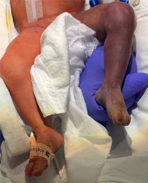 Paciente 2. Isquemia arterial aguda de miembro inferior izquierdo. Se objetiva palidez/cianosis de todo el miembro inferior izquierdo, con pie caído.