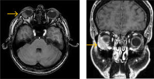 Resonancia magnética orbital con contraste de control a los 3 meses del diagnóstico. Se puede notar disminución evidente de la lesión extraocular con. relación a la Fig. 1. Paciente estuvo con dosis medias de prednisona.