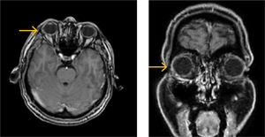 Resonancia magnética a los 6 meses de terapia doble con azatioprina y prednisona Se puede notar ausencia de la lesión original visible en las figuras 1 y 2. Paciente no volvió a presentar dolor ocular derecho.