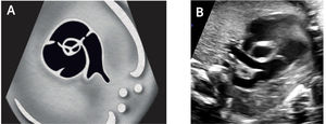 Imagen del arco aórtic A. esquema; B. imagen modo B; C. imagen Doppler color.