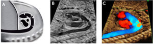 Arco ductal A. esquema; B. imagen modo B; C. imagen Doppler color.