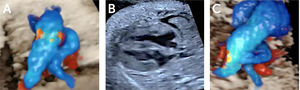 Cardiopatías en enfermedades por gen único A. Doble tracto de salida ventrículo derecho, B. Miocardiopatía hipertrófica, C. Hipoplasia de arco aórtico.