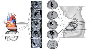Planos de sección transversales ascendentes Desde caudal a cefálico, abdomen, cuatro cámaras, tracto de salida de aorta, tracto de salida de pulmonar, tres vasos tráquea. Muñoz H, et al.4.