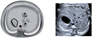 Imagen de axial de abdomen A Esquema, B imagen modo B.