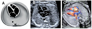 Visión de 4 cámaras del corazón fetal A. Esquema, B. imagen modo B, C. imagen Doppler color. AD= aurícula derecha; VD= ventrículo derecho; AI= aurícula izquierda; VI= ventrículo izquierdo.