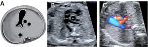Imagen de tracto de salida de ventrículo A. Esquema, B. imagen modo B, C. imagen Doppler color. Ao= aorta; Pulm= arteria pulmonar y sus dos ramas.