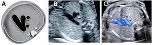 Imagen de tres vasos A. Esquema, B. imagen modo B, C. imagen Doppler color.