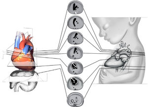 Planos de sección transversales ascendentes Desde caudal a cefálico, abdomen, cuatro cámaras, tracto de salida de aorta, tracto de salida de pulmonar desde la emergencia, división en ramas, confluencia en ductus arterioso, y tres vasos tráquea. Muñoz et al47.