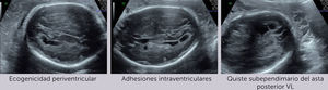 Alteraciones cerebrales fetales al ultrasonido prenatal en feto con infección por CMV.