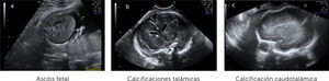 Alteraciones fetales al ultrasonido prenatal en feto con infección por CMV Imagen “c” gentileza de la Dra. Pilar Martínez Ten. Delta Ecografía, Madrid España.
