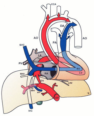 Central circulatory pathways of the fetus Via sinistra (red) directs well-oxygenated umbilical blood from the umbilical vein (UV), through the ductus venosus (DV) across the proximal inferior vena cava (IVC) to pass through the foramen ovale (FO) above the foramen ovale valve (FOV) to reach the left atrium (LA) and the left ventricle (LV) to be pumped into the aorta (AO) feeding the coronary arteries, head and arms before reaching the descending AO. Via dextra directs low-oxygenated blood (blue) from the superior vena cava (SVC) and inferior vena cava (IVC) through the right atrium (RA) to the right ventricle (RV) where it is pumped into the pulmonary artery (PA) and ductus arteriosus (DA) to reach the descending AO. CCA, common carotic arteries; LHV, left hepatic vein; LP, left portal branch; MHV, medial hepatic vein; MP, main portal vein; PV, pulmonary vein; RHV, right hepatic vein; RP, right portal branch (modified with permission11).
