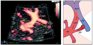 Details of the left portal vein connections visualized using power Doppler sonography A magnified sketch (right panel) clarifies the details. The site for Doppler recording of the LPV would be the section between the istmus of the ductus venosus (DV) and the junction with the portal vein (PV) and the right portal vein (RPV). The insonation should be aligned and the sample volume reduced to 2-3mm to minimize interference. AHP, arteria hepatica; S, stomach; UV, umbilical vein33.