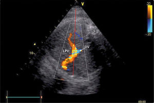 Doppler insonation of the left portal vein (LPV) Doppler insonation (red line) of the left portal vein (LPV) in an almost transverse scan at the level of the inlet of the ductus venosus (DV) aligning the Doppler beam with the LPV from the posterior right side of the fetus. Color Doppler optimized for velocities of 10-25 cm/s confirms identification and connection to the umbilical vein (UV). The opposite direction is also favorable, should the fetus rotate 180̊. Spine (S).
