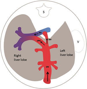 The left portal vein (PV) directs umbilical flow beyond the ductus venosus (DV) towards the right side to the junction with the portal stem, or the main portal vein (PV), where umbilical blood blends in with low-oxygenated splanchnic blood and enters the right portal branch and liver lobe. LPV constitutes a watershed area where blood may even reverse to feed splanchnic blood into the umbilical vein and ductus venosus when perfusion pressure in the umbilical vein is low. After birth when the umbilical vein obliterates, the velocity is permanently reversed, and the portal stem circulates both right and left liver lobes. S, spine; UV, intra-abdominal umbilical vein; V, stomach33.