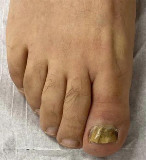 Uña del primer ortejo del pie derecho con xantoniquia, hiperqueratosis subungueal y onicolisis.