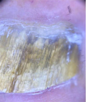 Dermatoscopía de la uña del primer ortejo derecho: estrías longitudinales amarillentas y borde proximal dentado.