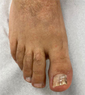 Seis meses con tratamiento tópico. Se observa disminución de xantoniquia e hiperqueratosis subungeal.