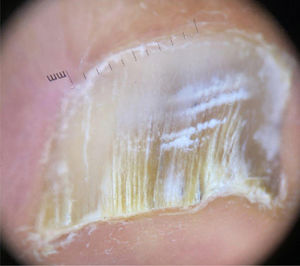 Dermatoscopía luego de seis meses con tratamiento tópico. La uña proximal se encuentra sana.