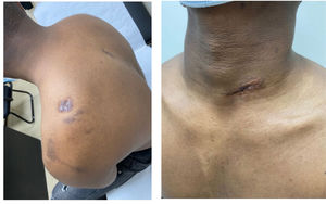 Paciente posterior a terapia combinada.