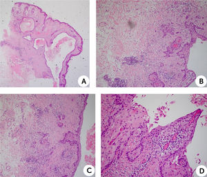 Histología de lesión quística revestida por epitelio escamoso maduro con diferentes grados de displasia epitelial. A la histopatología con tinción H&E de la lesión extirpada muestra una epidermis con ortoqueratosis más una discreta pigmentación del estrato basal, dermis con lesión quística revestida por epitelio escamoso maduro con diferentes grados de displasia epitelial (A, lupa de aumento 4x) y desarrollo de una neoplasia maligna de estirpe epitelial, conformada por células de pleomorfismo moderado, citoplasma amplio eosinófilo y núcleos con nucleolo prominente (B, C y D, aumentos 10x y 40x). El tumor infiltra extensamente el intersticio adyacente al quiste hasta la hipodermis superficial, formando perlas córneas (C, 10x). con bordes laterales y profundos libres de tumor. No se observaron infiltraciones vasculares ni perineurales.
