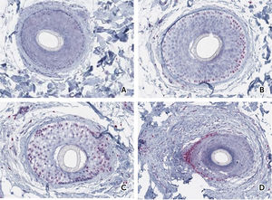 Expresión del receptor de andrógenos mediante inmunohistoquímica. en el folículo piloso (biopsia de cuero cabelludo). Se construyó una escala de acuerdo al porcentaje de células foliculares que expresaron receptores de andrógenos. A, puntuación=0 (menos del 10% de células inmunorreactivas). B, puntuación=1 (10-30% de células inmunorreactivas). C, puntuación=2 (31-70% de células inmunorreactivas). D, puntuación=3 (>70% de células inmunorreactivas).