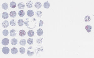 Micromatrices de tejido de cuero cabelludo de pacientes con alopecia frontal fibrosante clínica e histopatología de alopecia frontal fibrosante/líquen plano pilar. Tinción H&E. Se incluyeron controles positivo y negativo, ubicados en la esquina inferior izquierda.