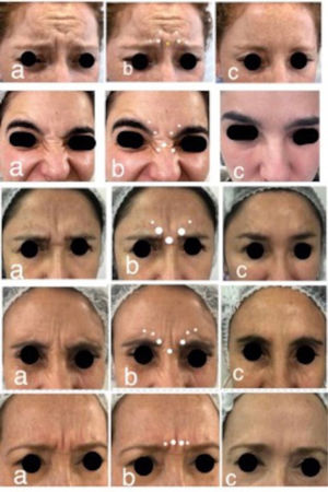 Patrones de contracción glabelar. a. Pacientes en contracción glabelar, en orden descendente: omega, omega invertido, U, V, fuerzas convergentes, b. Puntos sugeridos de aplicación de toxina botulínica. c. Resultado post aplicación.
