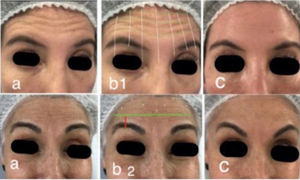 Delimitación de la zona de tratamiento frontal. a. Pacientes en contracción frontal completa. b1. Cuadriculado sugerido con posibles 21 puntos de aplicación de toxina botulínica. b2 Línea horizontal 2 o 3cm sobre el borde orbitario, los puntos de aplicación se ubican sobre esta línea. c. Resultado post aplicación.