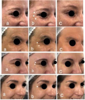 Patrones de contracción orbicular. a. Pacientes en contracción orbicular, en orden descendente: orbicular completa, inferior, superior y medial, b. Puntos sugeridos de aplicación de toxina botulínica. c. Resultado post aplicación.