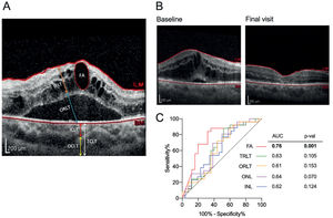 Retina and choroid segmentation (A) Retina and choroid segmentation using SD-OCT; (B) Structural changes before and after treatment in patients who received 3 doses of IVR injections due to DME; (C) Receiver operating characteristics (ROC) curve analysis. ROC curve of INL, ONL, TRLT, ORLT, and FA for the assessment of ranibizumab effectiveness. FA, fluid area; IRLT, inner retinal layer thickness; ORLT, outer retinal layer thickness; TRLT, total retinal layer thickness; ICLT, inner choroidal layer thickness; OCLT, outer choroidal layer thickness; TCLT, total choroidal layer thickness; INL, inner retina layer; ONL, outer retina layer.
