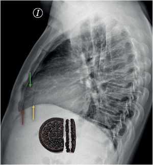Signo de la galleta Oreo® secundario a derrame pericárdico Paciente masculino de 34 años (mismo paciente) con el signo de la galleta Oreo® secundario a derrame pericárdico. Hallazgos: Radiografía lateral de tórax mostrando el signo de la galleta Oreo®. la radiolucidez de la grasa epicárdica (flecha amarilla) se intercala con la grasa mediastinal (flecha roja), separada de líquido pericárdico (flecha verde). Técnica: Radiografía lateral de tórax. Carestream DRX-1 system.
