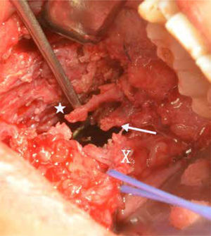 Nervio lingual y alveolar inferior cortados Vista cabo proximal La flecha muestra el cabo proximal del nervio lingual. El asterisco (*) muestra el cabo proximal del nervio alveolar inferior por lateral del nervio lingual. La X muestra el cabo distal del nervio lingual.