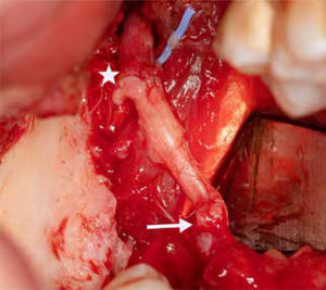Se muestra reconstrucción con injerto del nervio sural La flecha muestra Neurorrafia microquirúrgica del cabo distal nervio lingual. El asterisco (*) muestra neurorrafia microquirúrgica del cabo proximal del nervio lingual.