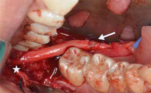 Se muestra la reconstrucción con aloinjerto La flecha muestra Neurorrafia microquirúrgica del cabo distal nervio lingual. El asterisco (*) muestra neurorrafia microquirúrgica del cabo proximal del nervio lingual.