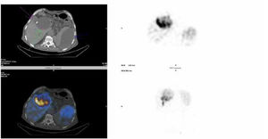 BrIDA SPECT/CT. The SPECT/CT images depict abnormal tracer accumulation in the liver; sub capsularly in the region of segment VIII (green arrow) as well as in the medial part of the right liver lobe (adjacent to the surgical drainage catheter insertion (pink arrow)). There is also increased tracer accumulation in the left upper abdominal quadrant (sub capsular region of the spleen (blue arrow)) which was due to bilomas.