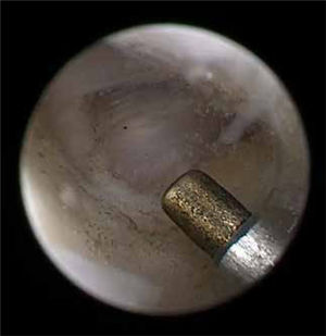 Miotomía del músculo pterigoídeo lateral realizada con radiofrecuencia.
