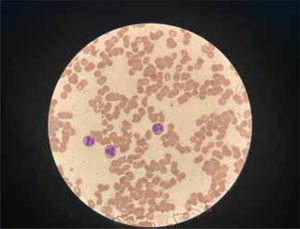 Microaglutinación y agregación de glóbulos rojos al frotis sanguíneo (100×).