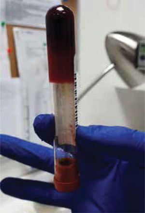 Macroaglutinación de glóbulos rojos.