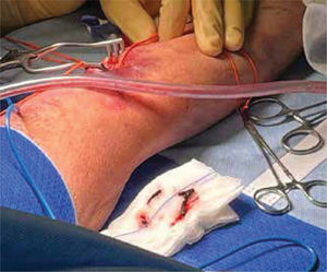 Tratamiento quirúrgico de trombosis arterial radial por embolectomía con balón de Fogarty.