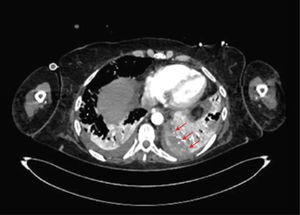 AngioTC pulmonar día 19 de evolución con evidencias de infarto pulmonar, indicado por flechas rojas.