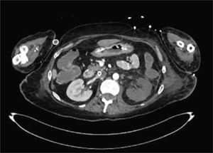 AngioTC de abdomen día 19 de evolución con evidencia de trombosis de arterial renal izquierda con ausencia completa contraste del mismo.